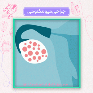جراحی میومکتومی