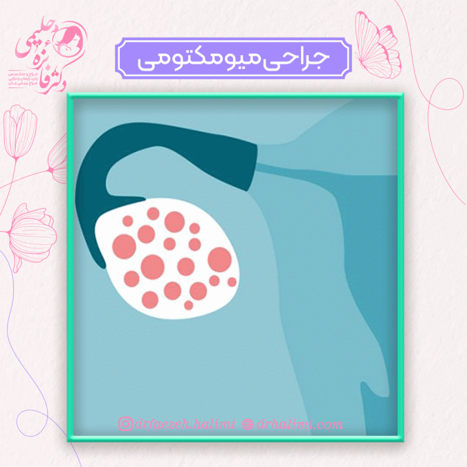 جراحی میومکتومی
