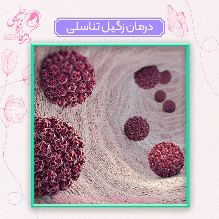 درمان زگیل تناسلی
