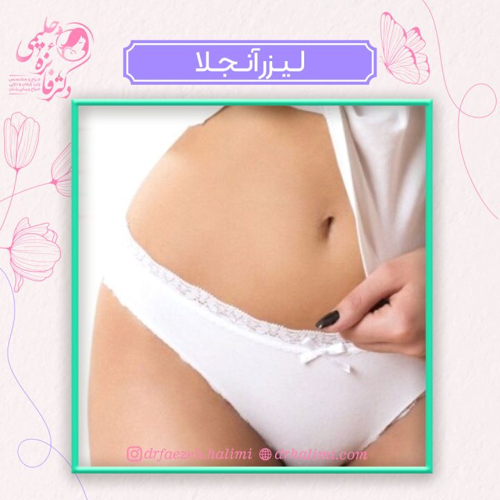 لیزر آنجلا چیست؟