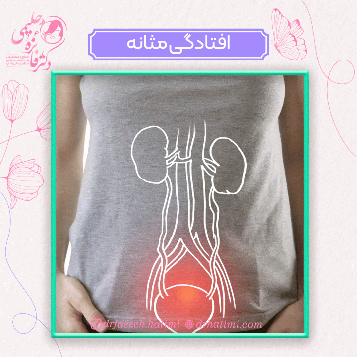 افتادگی مثانه