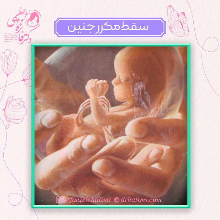 سقط مکرر جنین