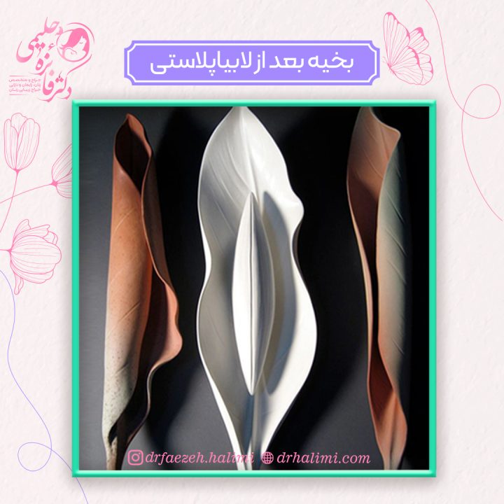 بخیه بعد از لابیاپلاستی