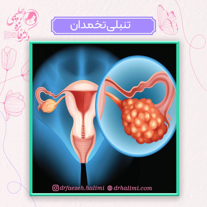 تنبلی تخمدان یا سندرم تخمدان پلی کیستیک