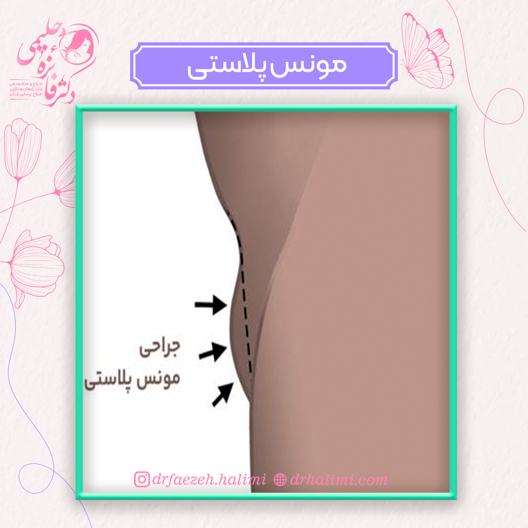 مونس پلاستی چیست؟