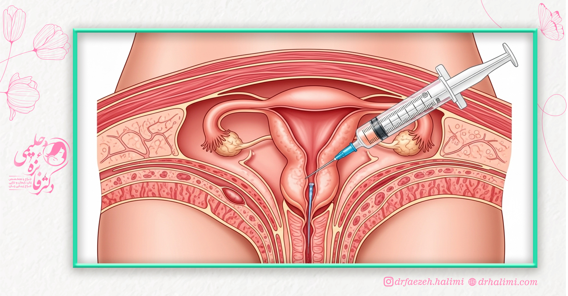 تکنیک های انتقال جنین