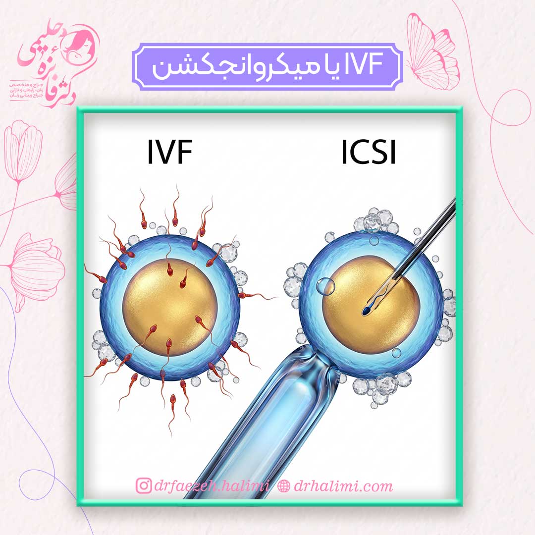 IVF یا میکروانجکشن